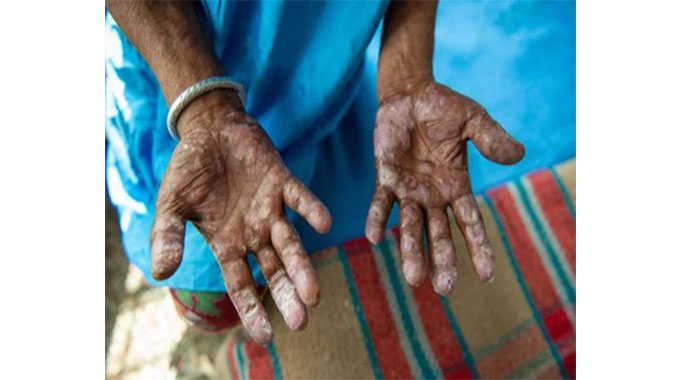 15 leprosy cases detected in Binga